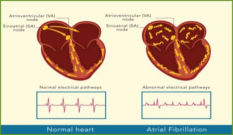 What is the difference between AF MF and AEL?